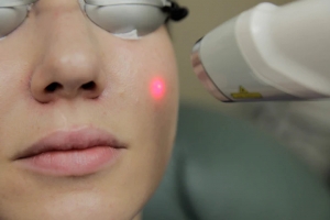 Laser Genesis: A Safe and Effective Solution for All Skin Types