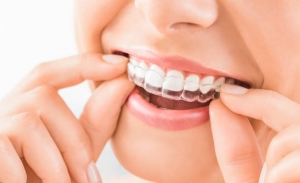 Revealing the Amazing Ways the Invisalign Work