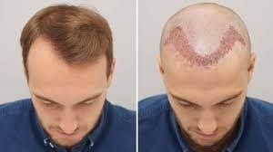 A Closer Look at FUE vs. FUT Hair Transplant in Dubai