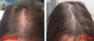 4 Top Benefits Of  Mesotherapy For Hair Loss Treatment