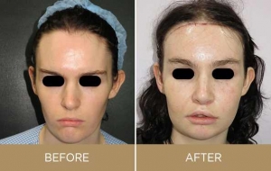 How can facial feminization surgery make you look more feminine?