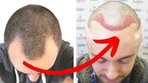 How to Choose the Best Hair Transplant Clinic in Sharjah
