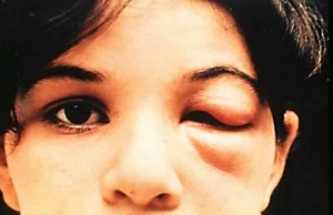 Chagas Disease Treatment: An Overview of Available Therapeutic Options 