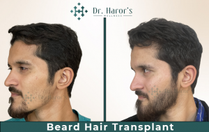 Is Beard Hair Transplant Good Option For Patchy Beard 