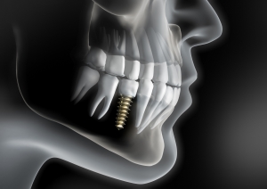 Understanding Dental Implant Systems: A Comprehensive Guide