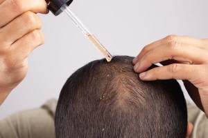 Hair Loss and Aging: What to Expect and How to Treat It