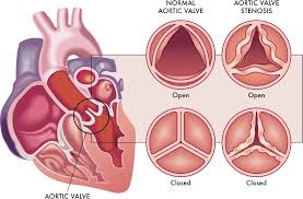 Aortic Stenosis Market is Anticipated to Witness High Growth Owing to Increasing Geriatric Population 