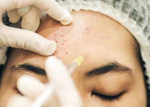 How to Treat Different Types of Acne