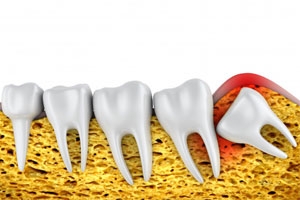 Top 5 Benefits of Choosing Dental Implants Over Other Tooth Replacement Options