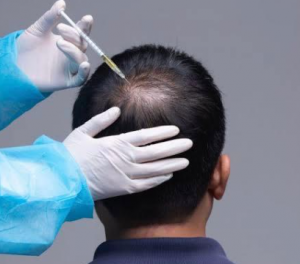 Top Hair Loss Treatments in London