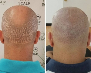 Scalp Micropigmentation for Women