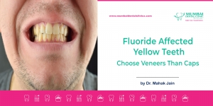 Fluoride Affected Yellow Teeth : Choose Veneers Than Caps