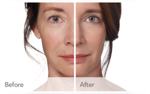 Dubai Radiesse Fillers: Achieve a Non-Surgical Nose Job