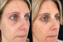 Dubai Radiesse Fillers: Enhance Your Facial Features Without Surgery