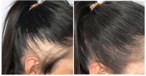 Upscale Hair Loss Solution Provider in Dubai