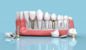 5 Reasons Why Dental Implants Are the Best Solution for Missing Teeth