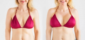 Top 10 Benefits of Getting a Breast Lift