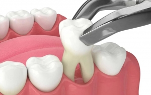 Budgeting for Impacted Wisdom Teeth Extraction: ACompleteGuide