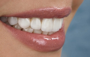 Finding the Best Veneer Dentist NearYou