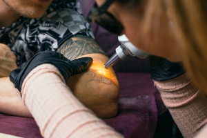 Affordable Laser Tattoo Removal Devices in Dubai