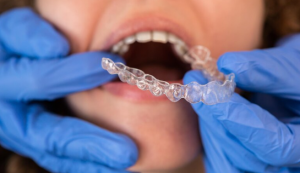 How do clear aligners straighten teeth with precision? Learn the science behind it