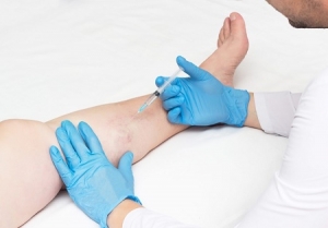 Step-by-Step Guide to the latest Varicose Veins Treatment