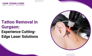 Tattoo Removal in Gurgaon: Experience Cutting-Edge Laser Solutions