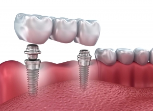 Affordable Dental Implants: Your Guide to Restoring Your Smile