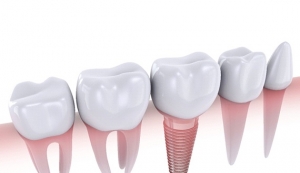 Permanent Dental Implants: A Lasting Solution for Missing Teeth in Waltham