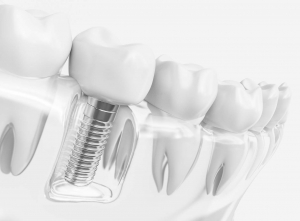 What is The Process for Getting Dental Implants in East River?