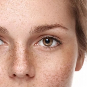 Customized Pigmentation Treatment Plans in Dubai