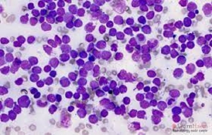 Acute Lymphoblastic Leukemia Market Size 2024: Epidemiology, Industry Trends and Forecast by 2034