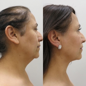 Say Goodbye To Double Chin With Neck Fat Removal Procedures