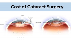 Cost of Cataract Surgery