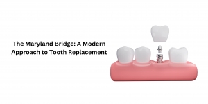 The Maryland Bridge: A Modern Approach to Tooth Replacement