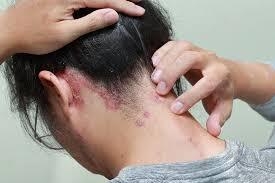 Prescription vs. Over-the-Counter Treatments for Scalp Psoriasis: A Comprehensive Guide