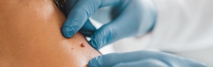 The Role of Technology in Skin Tag Removal Costs in Bangalore