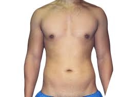 Benefits Of Laser Liposuction Over Traditional Liposuction