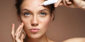 Treatments for Acne Scars: An In-Depth Overview