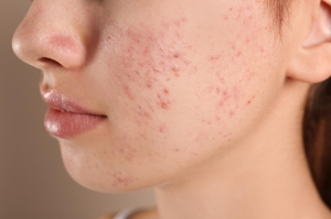 The Science Behind Pimples Treatment: What You Should Know