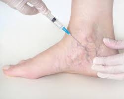 How Varicose Veins Treatment Can Improve Your Quality of Life