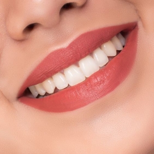 Composite Veneers: A Closer Look at the Process