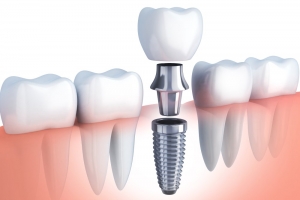 Dental Implants- Why are they the best choice for tooth loss management?