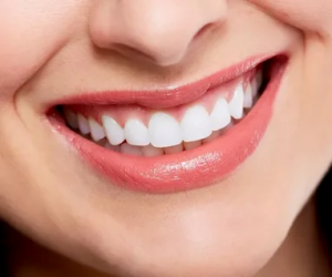 Understanding Gummy Smile Solutions in Dubai