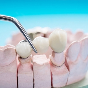 Recovery Tips After Dental Crown Placement in Islamabad