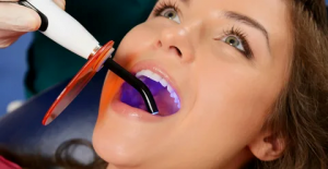 Top Reasons to Opt for Composite Fillings in Dubai