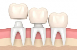 How EMAX Crowns Compare to Traditional Crowns in Dubai