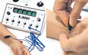 Top 5 Acupuncture Needle Stimulator Machines for Professional Use