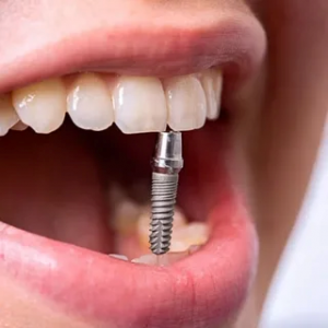 The Cost of Dental Implants in Dubai Explained