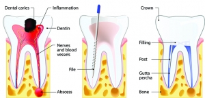 Root Canal: Is It the Best Option or Is There Another Way?